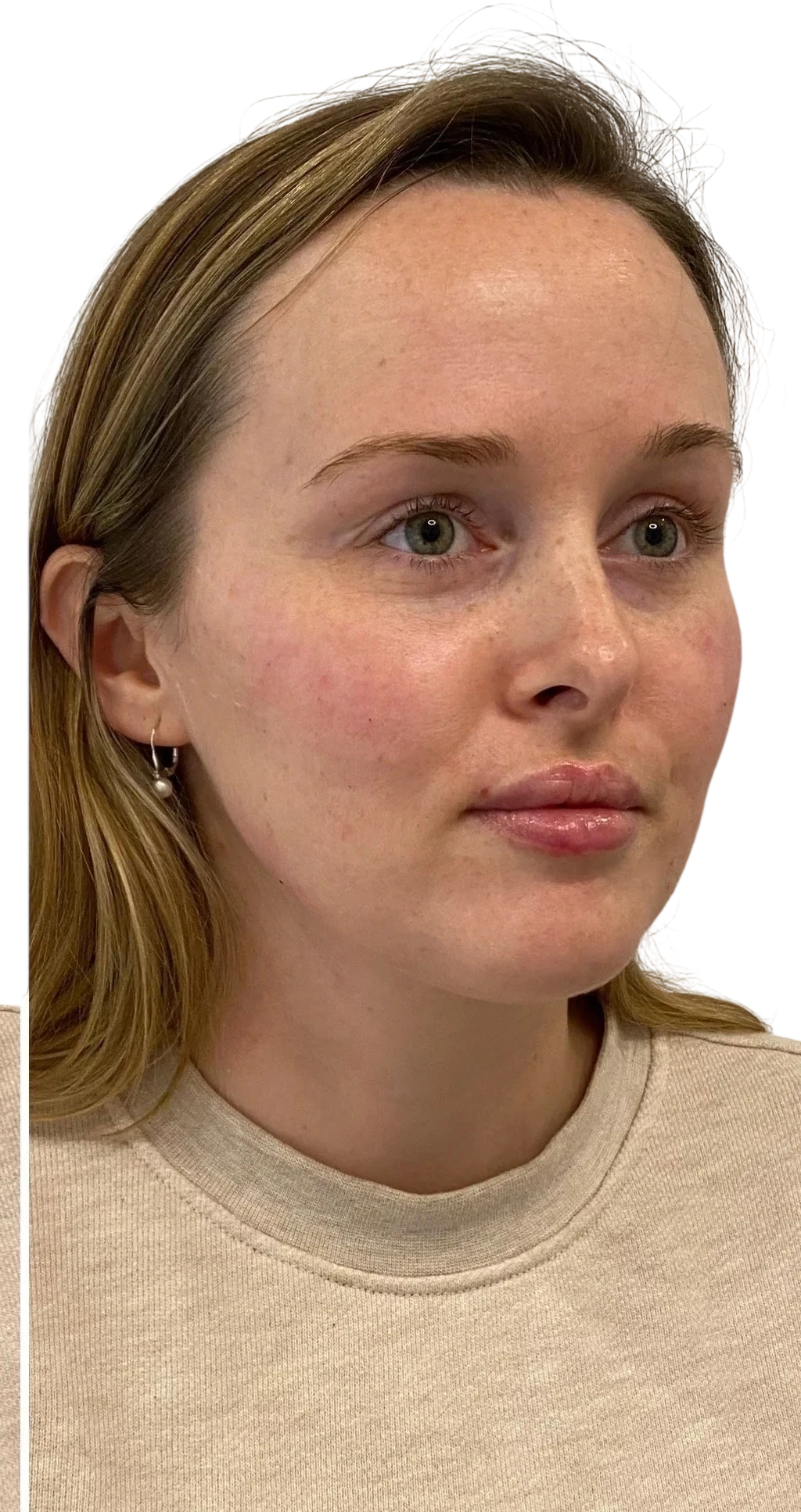 Nasolabial Folds Knoxville result 6 After