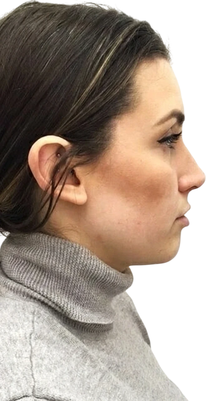 Nasolabial Folds Knoxville result 8 Before