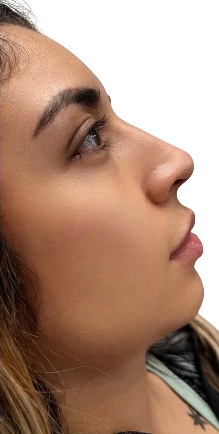 Nasolabial Folds Knoxville result 10 After