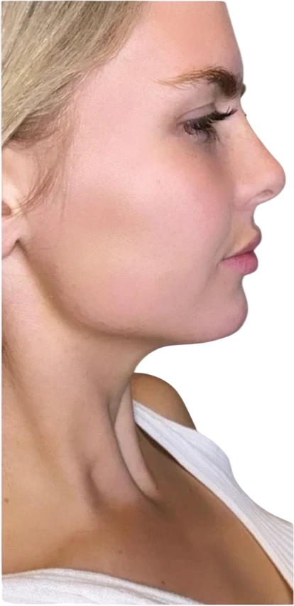 Jawline Filler Knoxville result 2 After