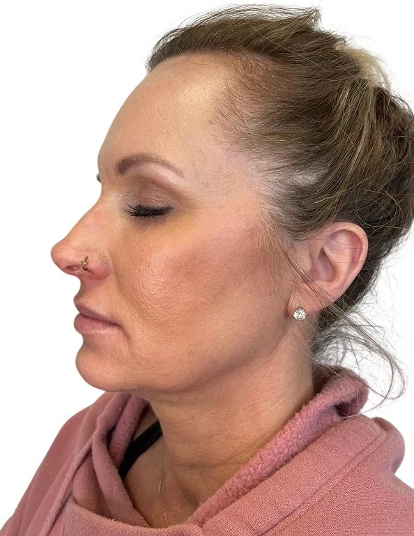 Jawline Filler Knoxville result 3 Before