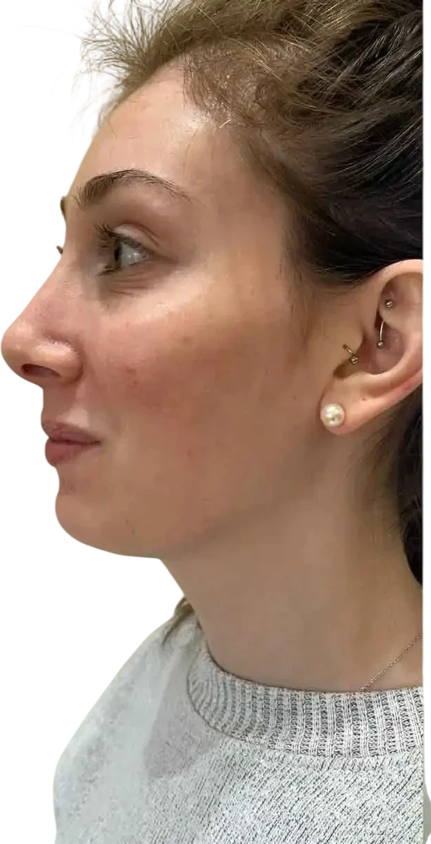 Jawline Filler Knoxville result 4 Before