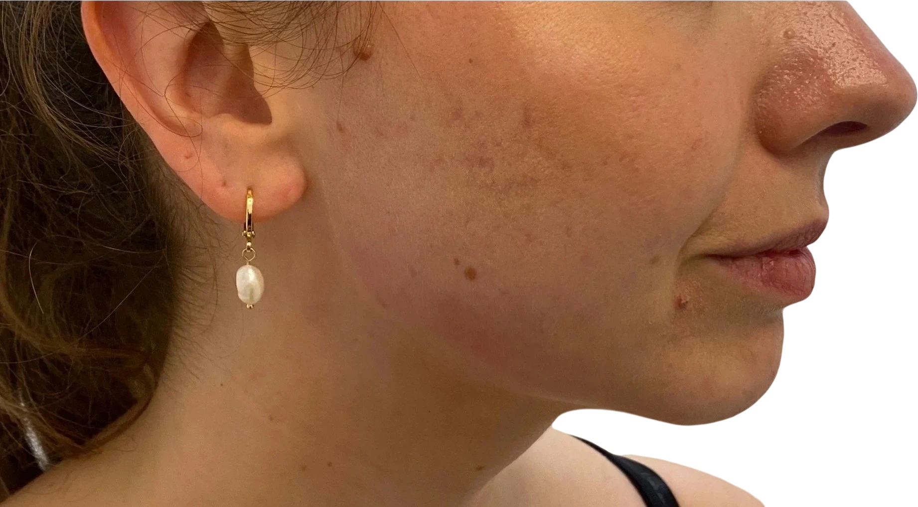 Jawline Filler Knoxville result 5 After