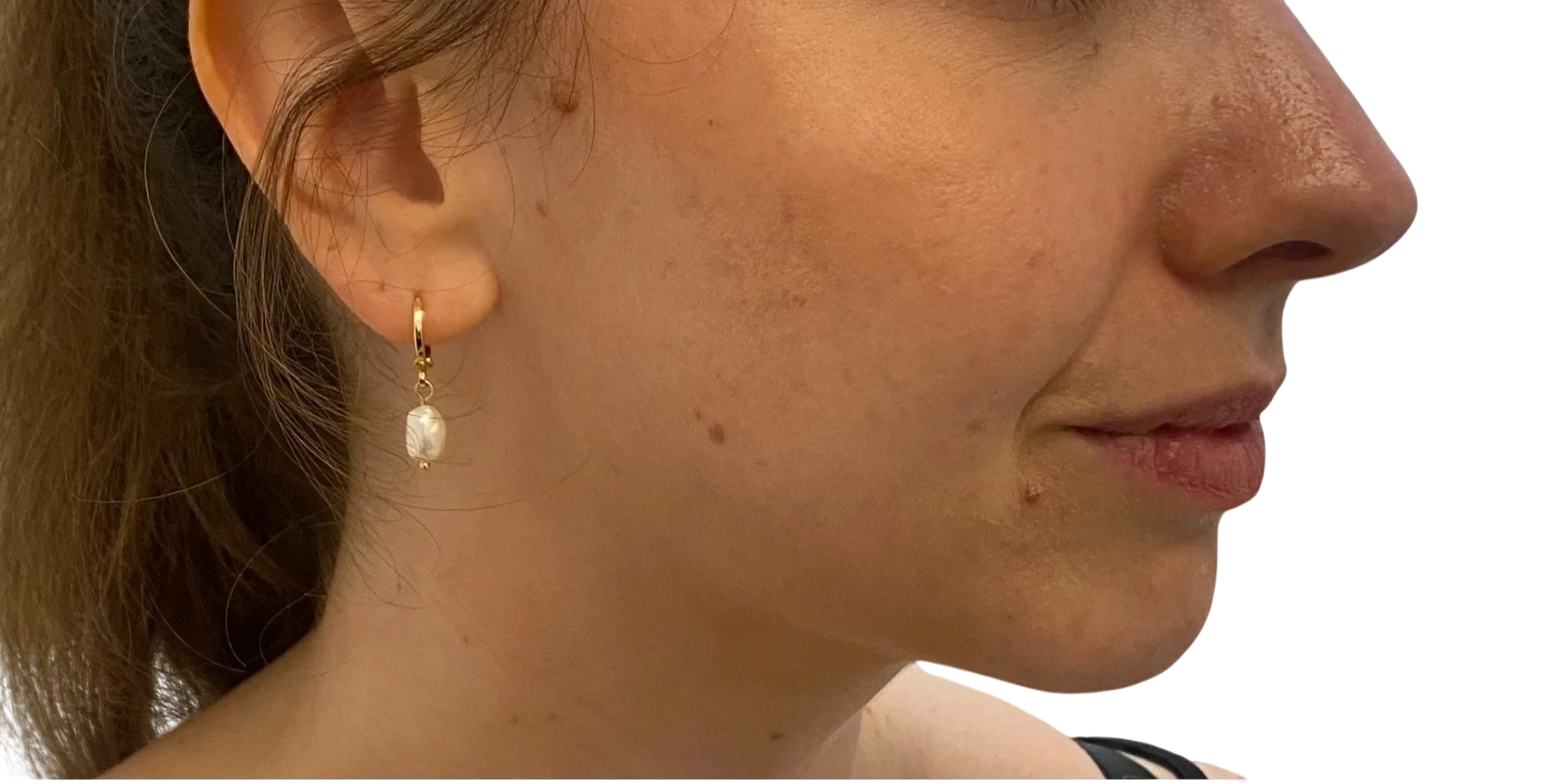 Jawline Filler Knoxville result 5 Before