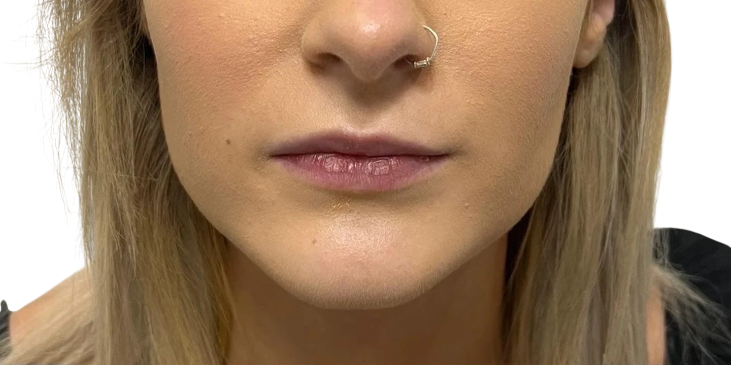 Lip Filler Knoxville result 3 Before