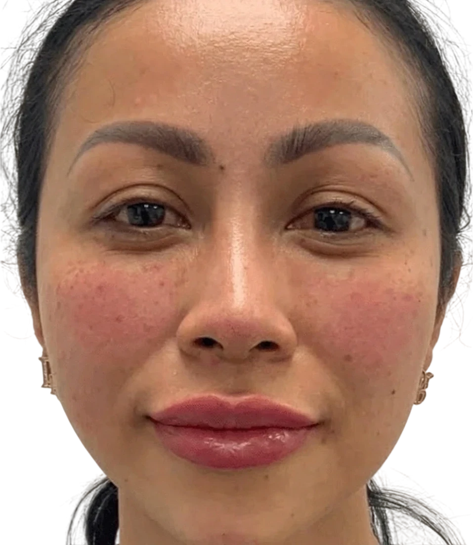 Lip Filler Knoxville result 4 After