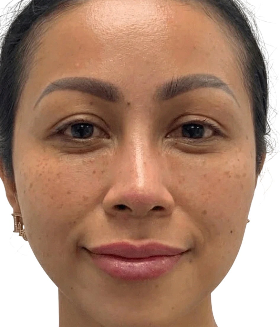 Lip Filler Knoxville result 4 Before