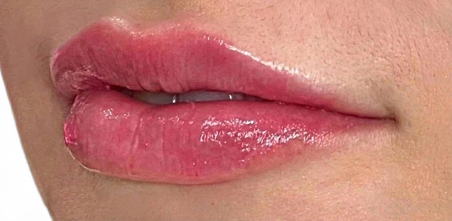 Lip Filler Knoxville result 5 After