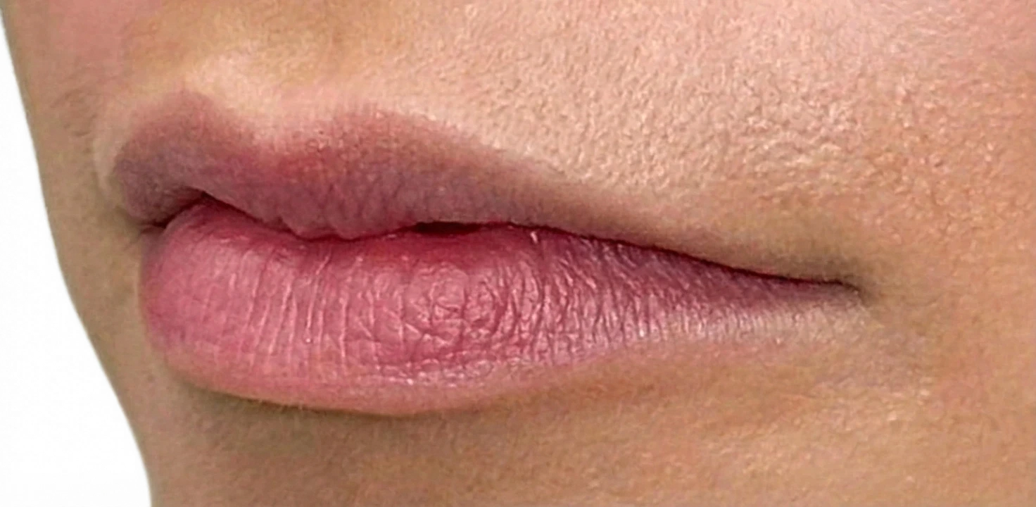 Lip Filler Knoxville result 5 Before