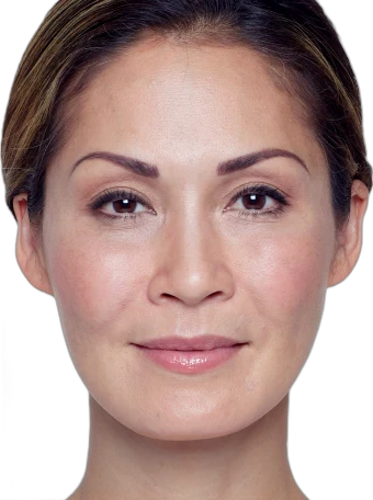 Nasolabial Folds after