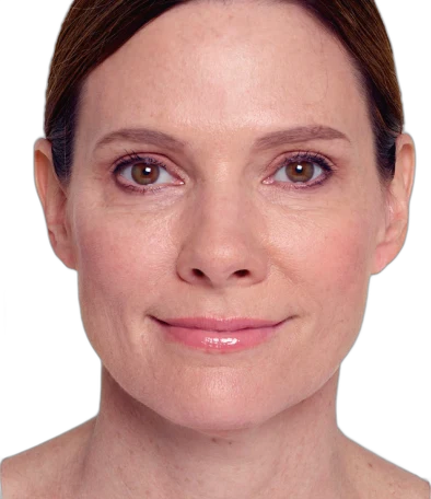 Nasolabial Folds Knoxville result 2 After
