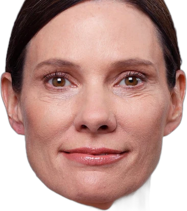 Nasolabial Folds Knoxville result 2 Before