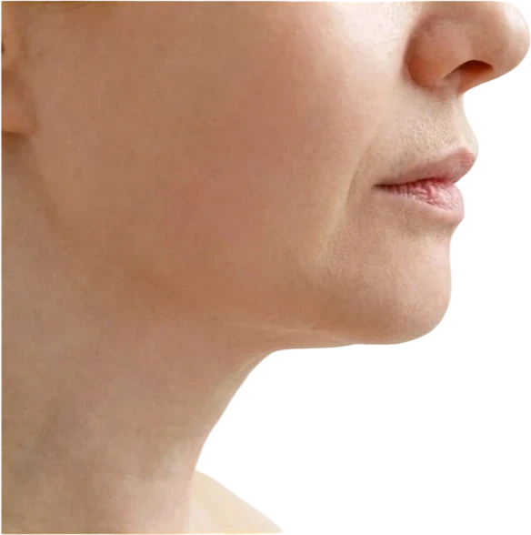 Kybella before