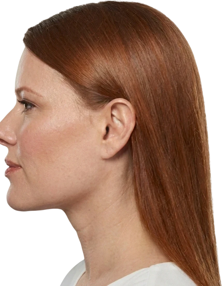 Kybella Knoxville result 2 After