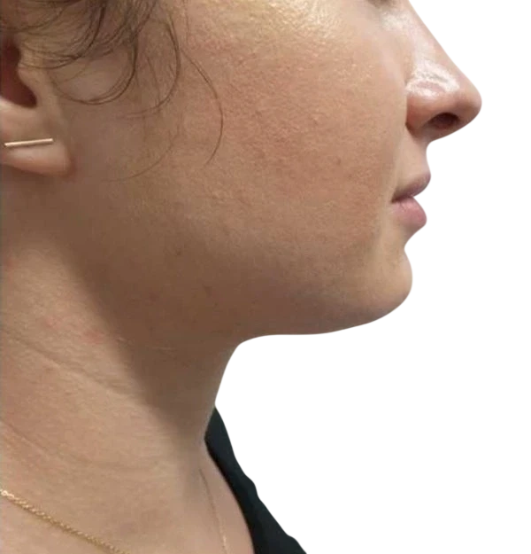 Kybella Knoxville result 4 After
