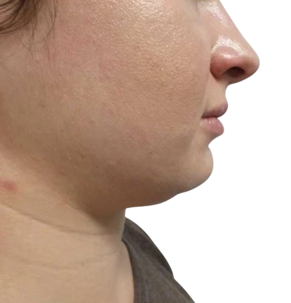 Kybella Knoxville result 4 Before