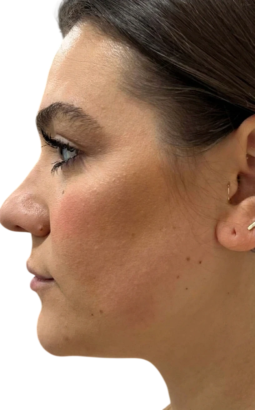 Kybella Knoxville result 5 After