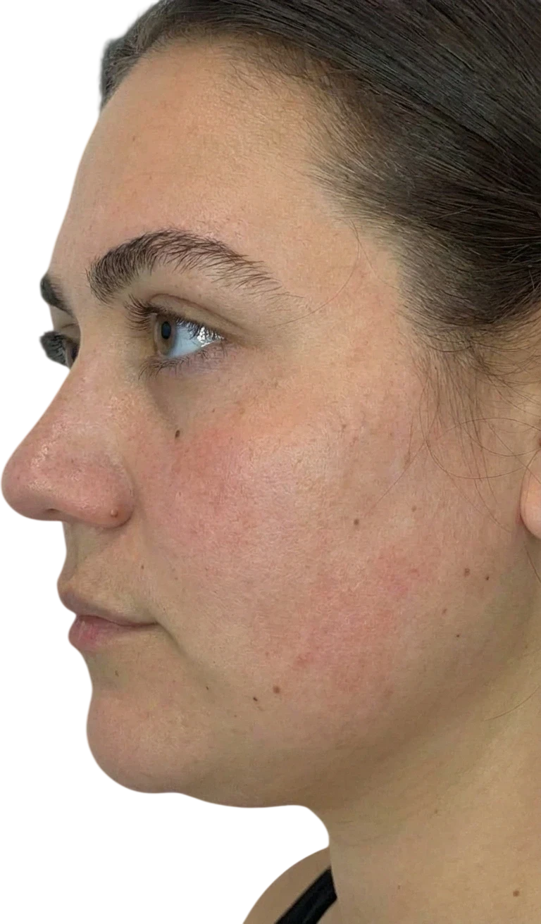 Kybella Knoxville result 5 Before