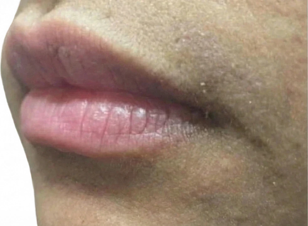 Laser Services after