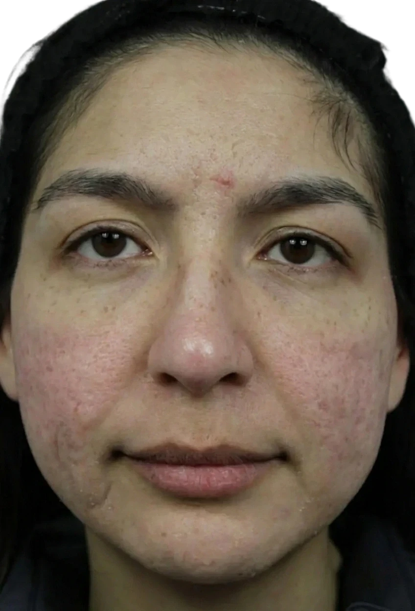 Microneedling after
