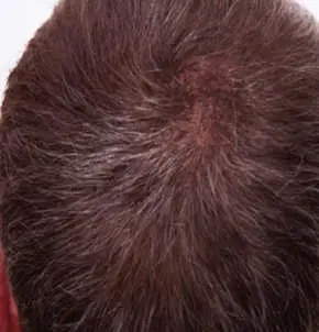 Hair Loss Microneedling