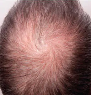Hair Loss Microneedling before