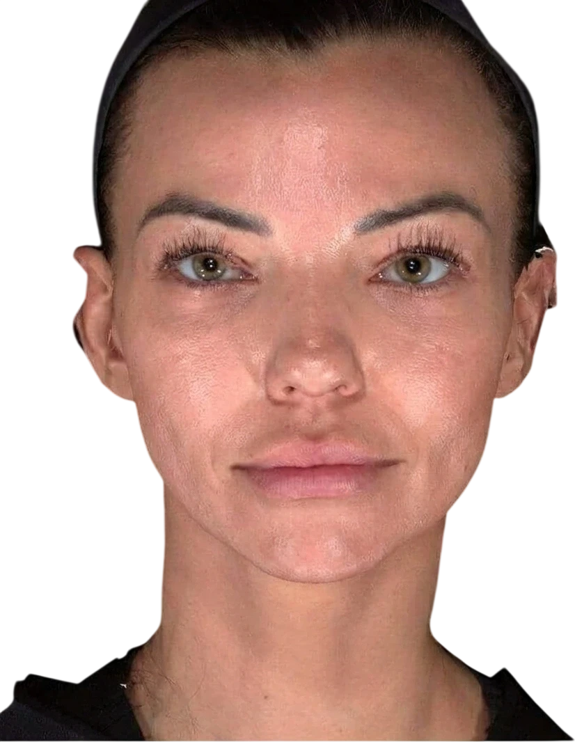 SkinVive Knoxville result 3 After