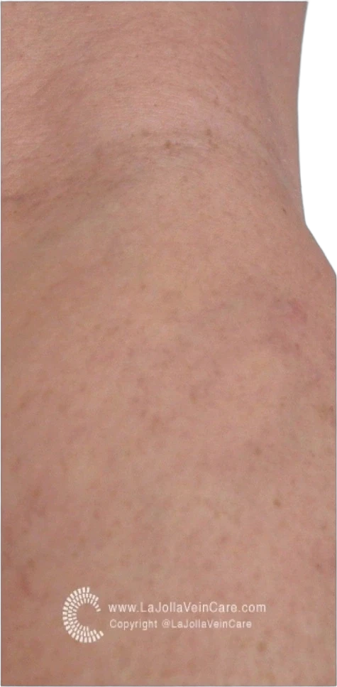 Vascular Lesion Reduction after
