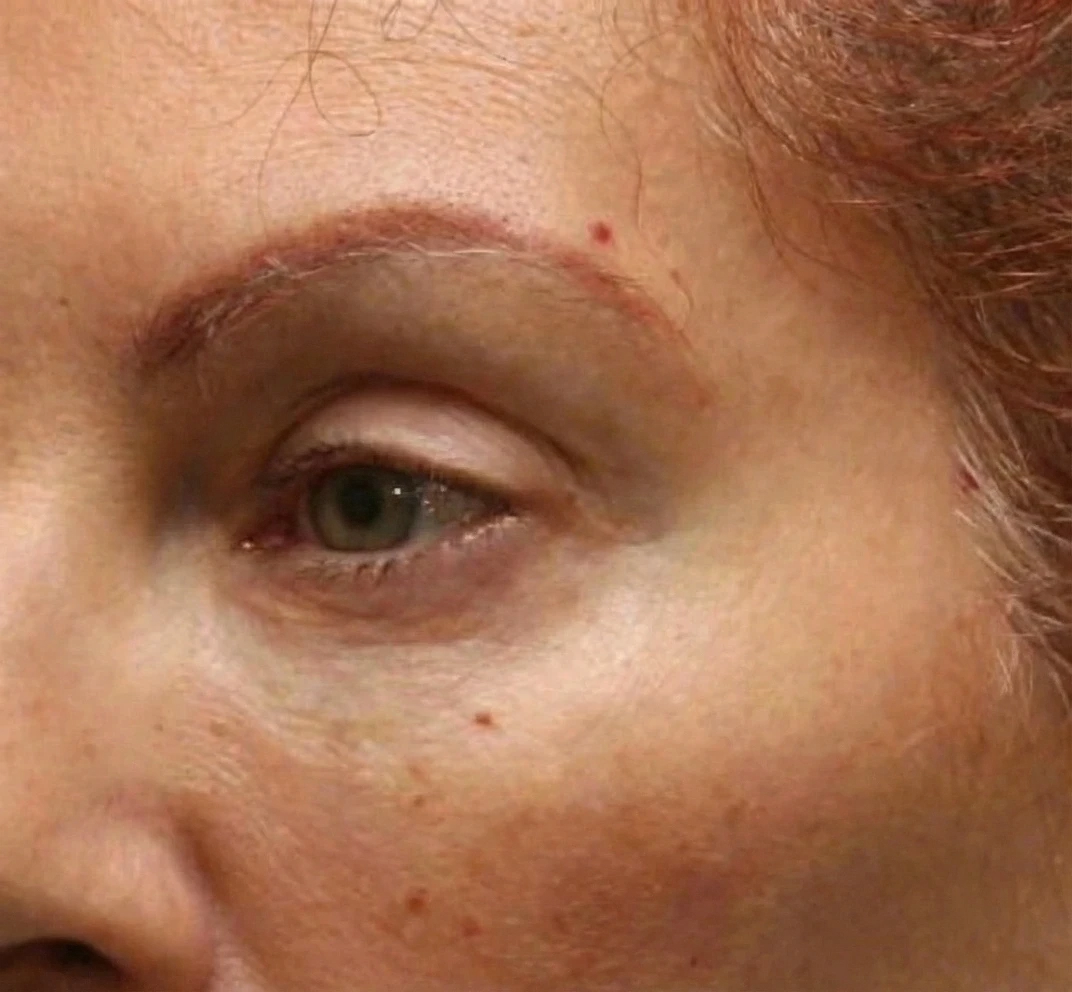 Brow Lift after