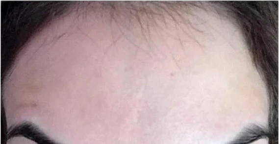 Forehead Lines after