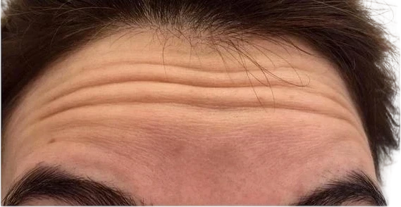 Forehead Lines before