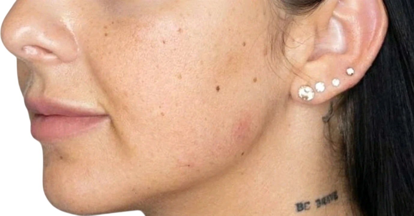 Jawline Filler after