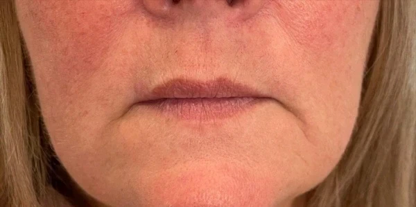 Lip Filler before