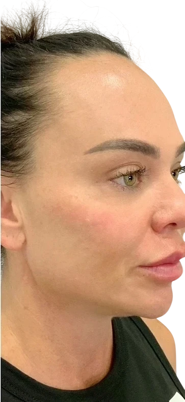 Nasolabial Folds after