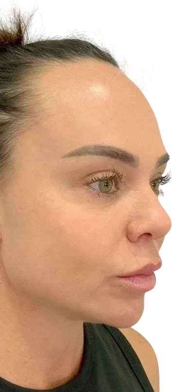 Nasolabial Folds before