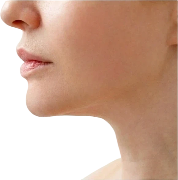 Kybella after treatment at Sarah Hitchcox Aesthetics