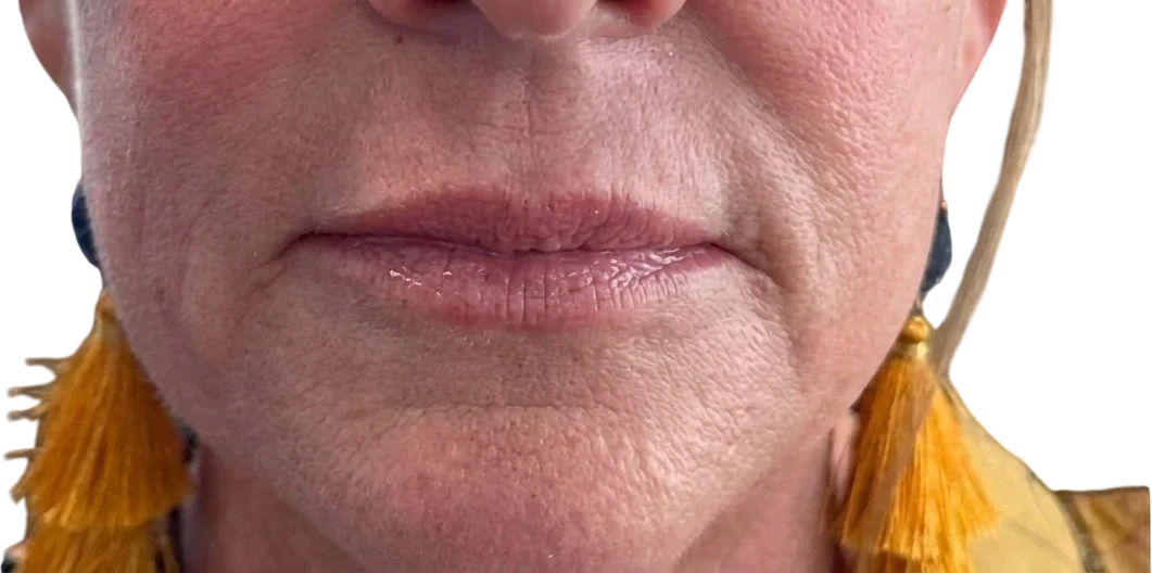 SkinVive before treatment at Sarah Hitchcox Aesthetics