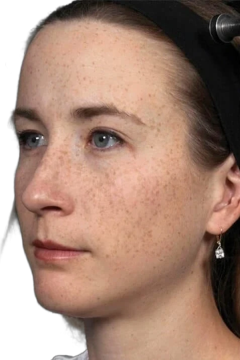 Everesse before treatment at Sarah Hitchcox Aesthetics