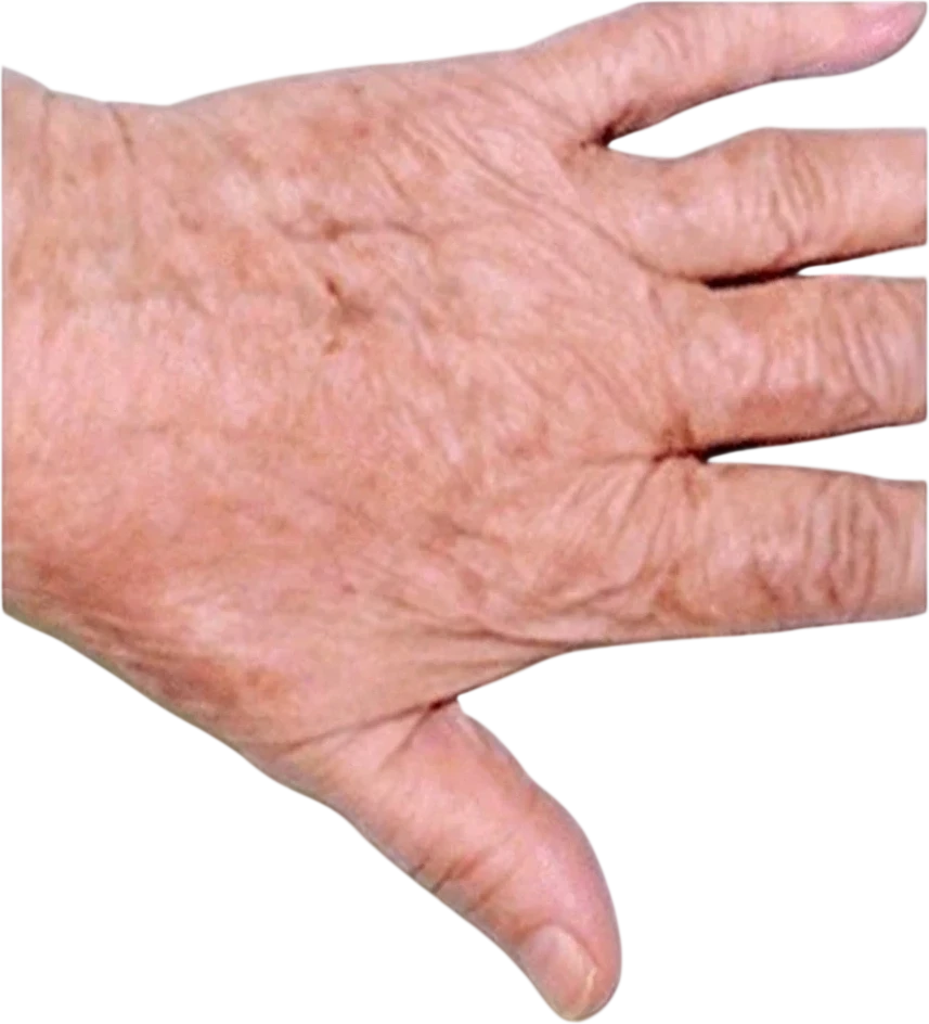 Pigmented Lesion Reduction