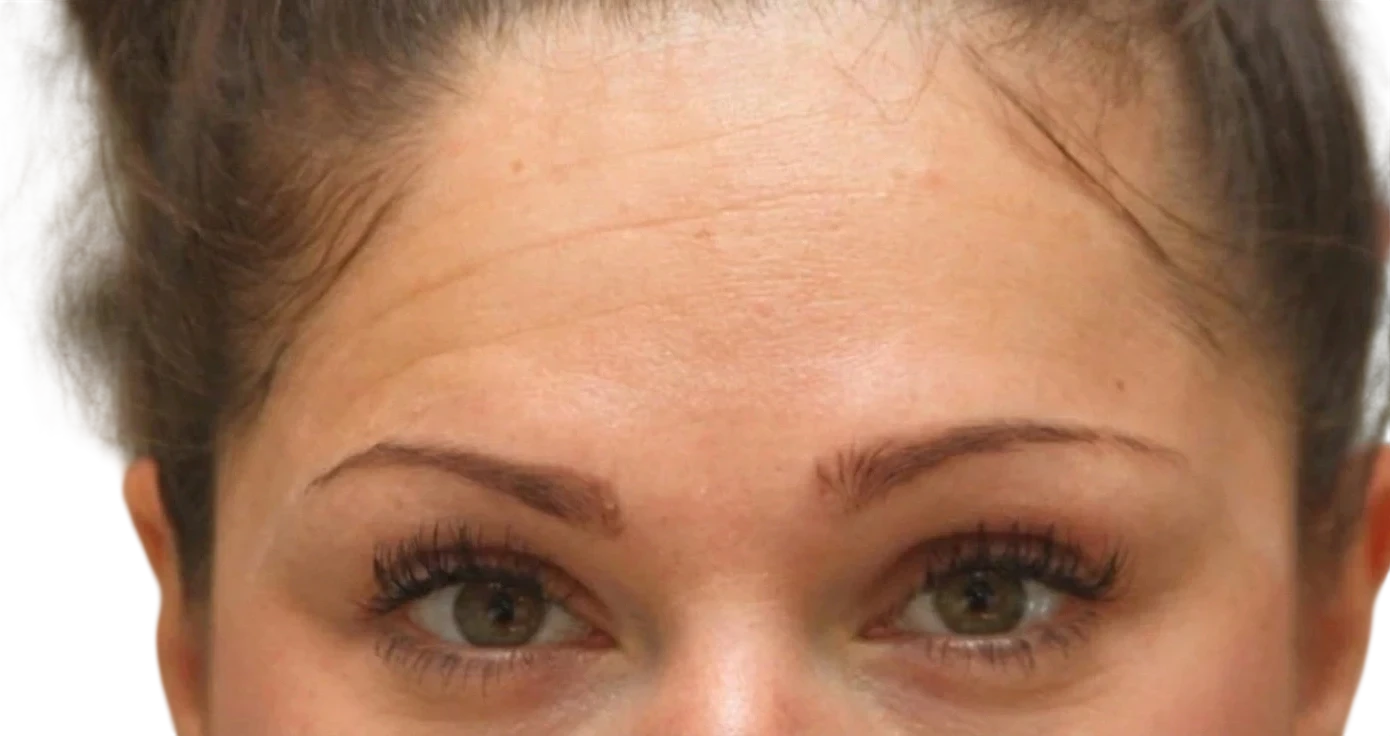 Brow Lift after