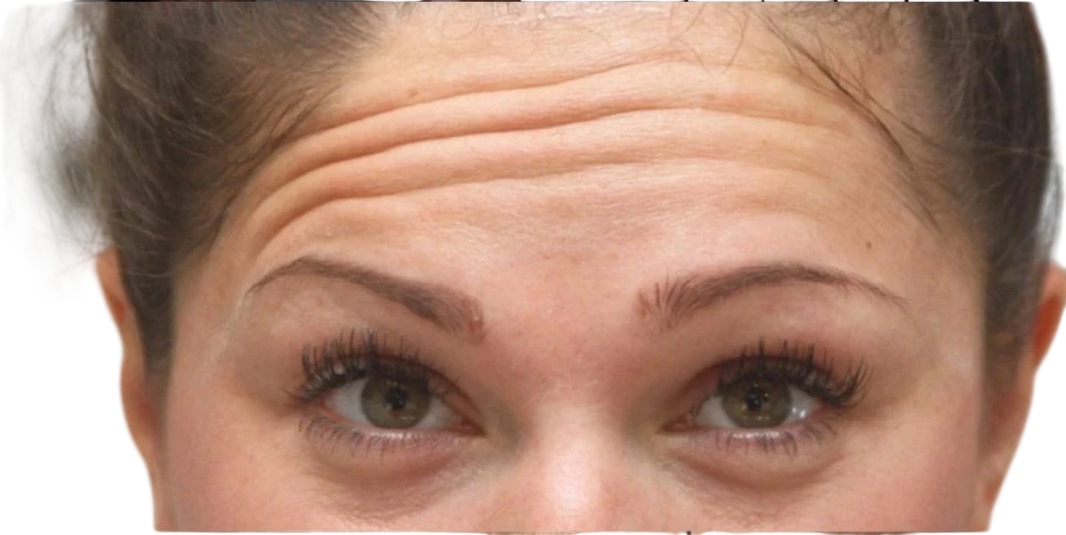 Brow Lift before