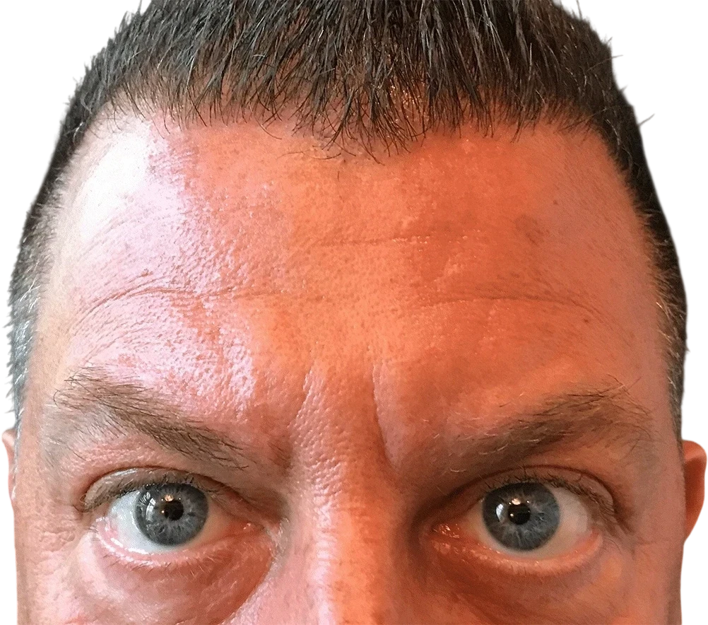 Forehead Lines before