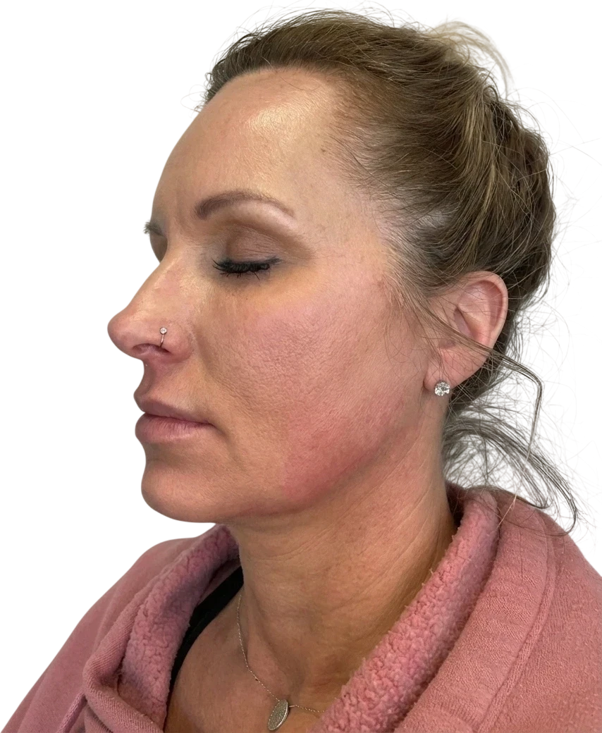 Jawline Filler after