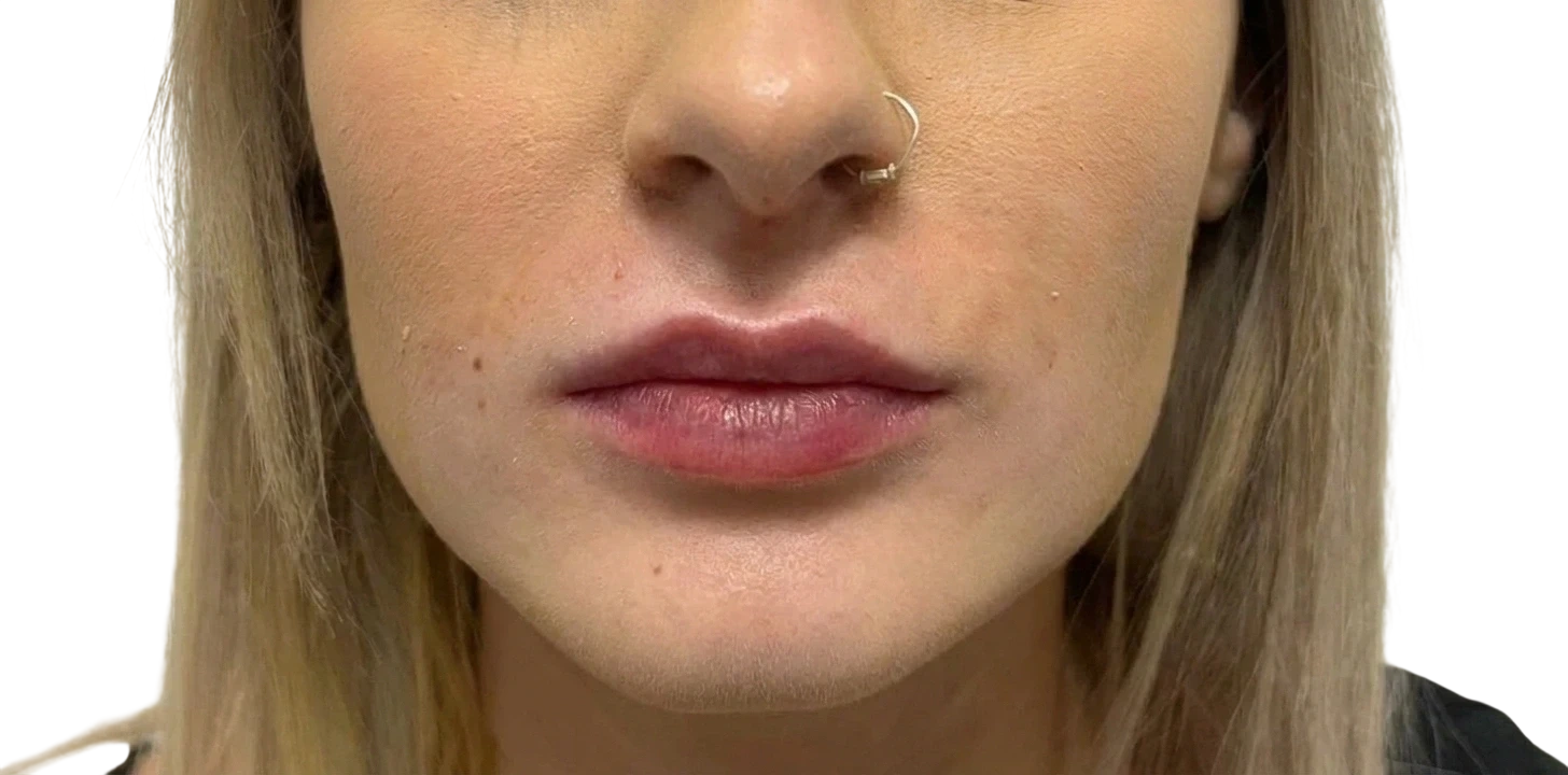 Lip Filler after