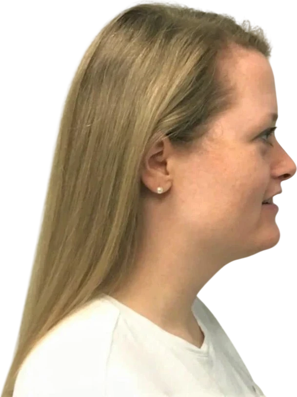 Kybella after