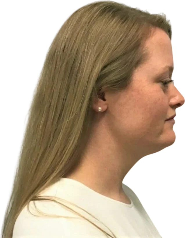 Kybella before