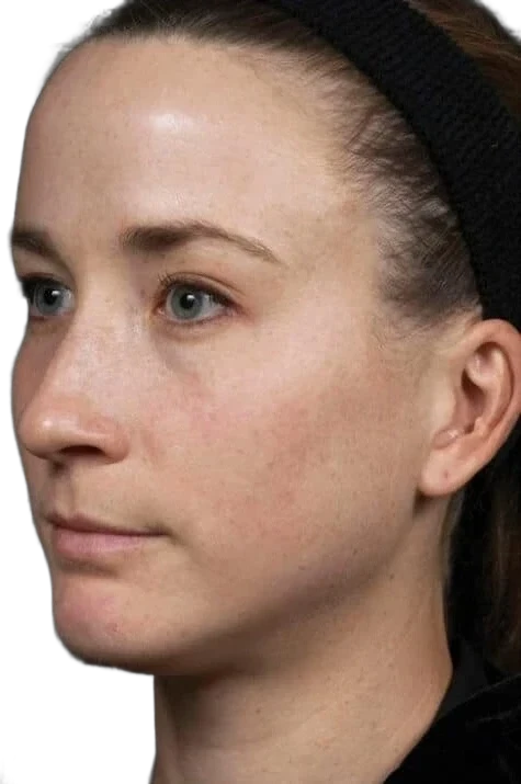 Everesse Jawline after