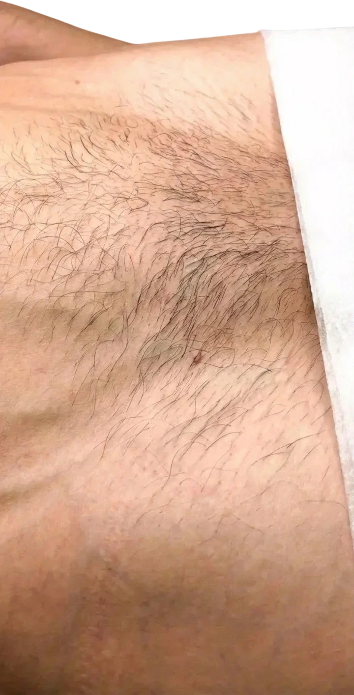 Laser Hair Removal before
