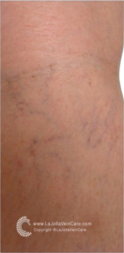 Vascular Lesion Reduction before