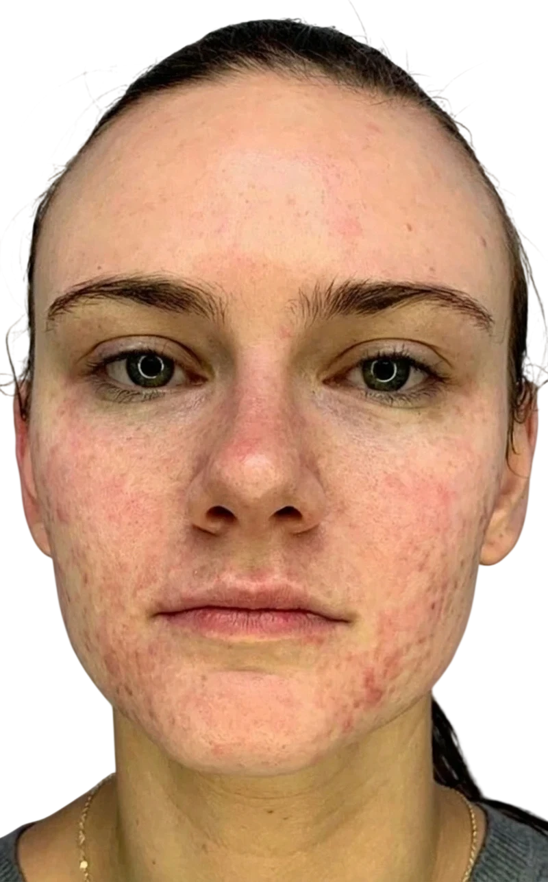 Face Microneedling before